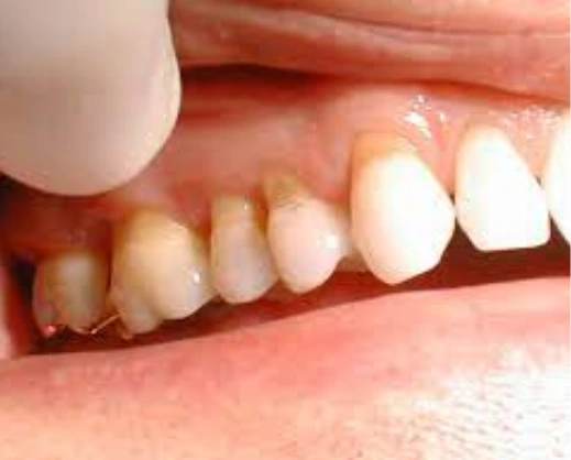 Як вибрати колір зубів?