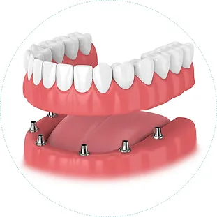 протезування зубів по технології all-on-x
