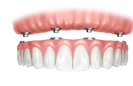Протезирование всей челюсти на 4-х, 6-х или 8-х имплантатах