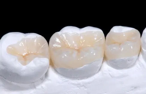 Керамічні вкладки