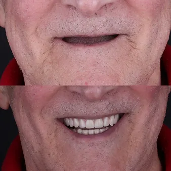 Имплантация зубов