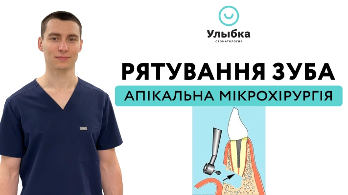 Рятування зуба за допомогою апікальної мікрохірургії. Клінічний Випадок. Одеса. Стоматологія Brillant Dental