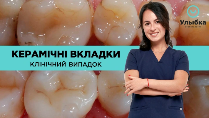 Реставрація зубів за допомогою керамічних вкладок. Клінічний Випадок. Одеса. Стоматологія Brillant Dental