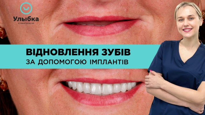 якісна імплантація зубів в Одесі