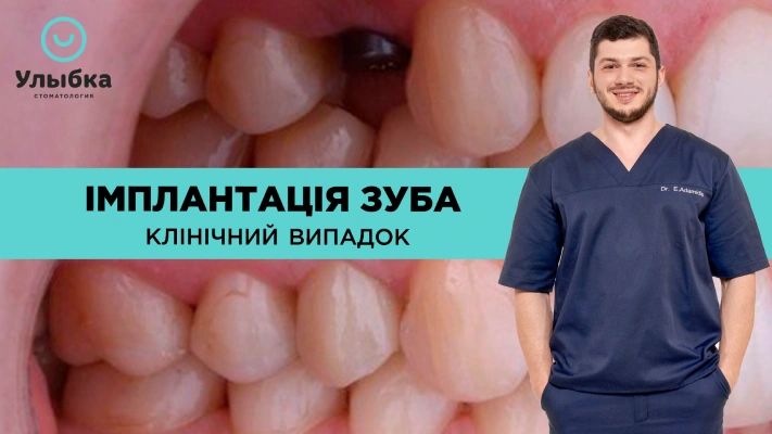 Імплантація зуба. Клінічний Випадок. Одеса. Стоматологія Brillant Dental