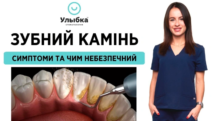 ЗУБНИЙ КАМІНЬ: симптоми і причини. Від чого з'являється камінь на зубах у дітей та дорослих