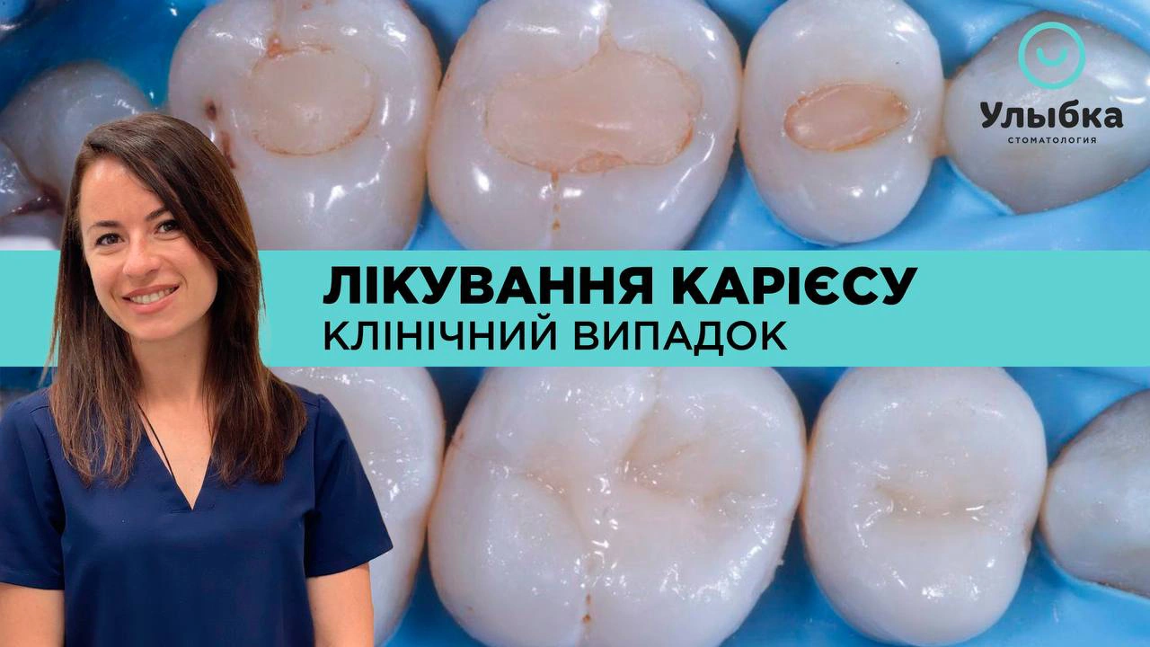 Як Відновити Зуби? Клінічний Випадок. Лікування Карієсу. Одеса. Стоматологія Brillant Dental