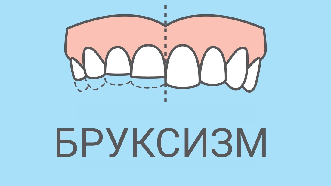 Бруксизм: причини, симптоми, профілактика та лікування