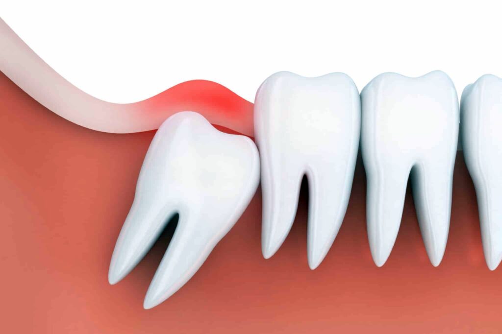 Навіщо потрібно видаляти зуби мудрості