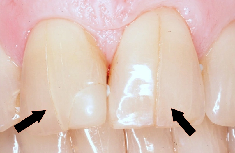 Тріщина на зубі: що робити?