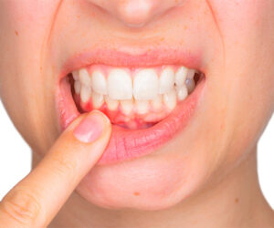 вавки, ранки или язвы во рту