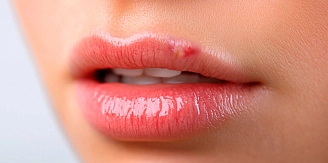 Герпес на губах і в роті: симптоми та як лікувати