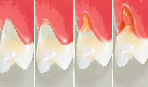 Клиновидный дефект зубов. Причины и лечение.