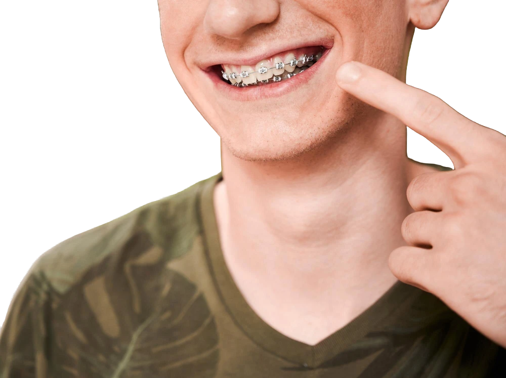 Сколько нужно носить брекеты?