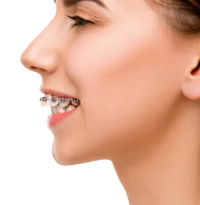 Дистальный прикус. Ортодонт Одесса