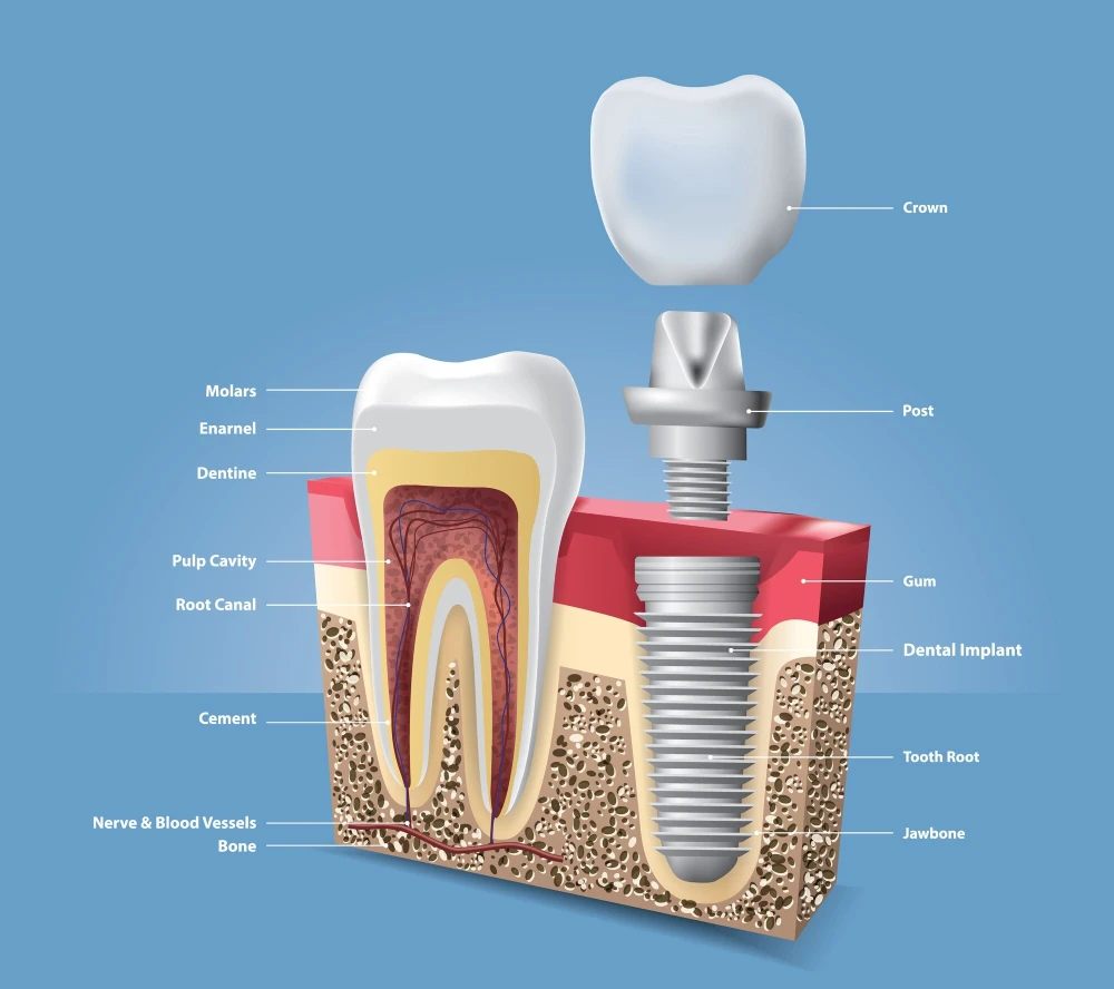 имплантация зубов в Одессе