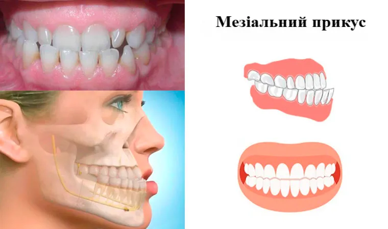 Мезіальний прикус. Ортодонт Одеса