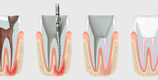 Лечение корневых каналов под микроскопом в Одессе