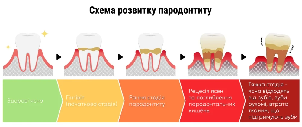 Причини пародонтиту